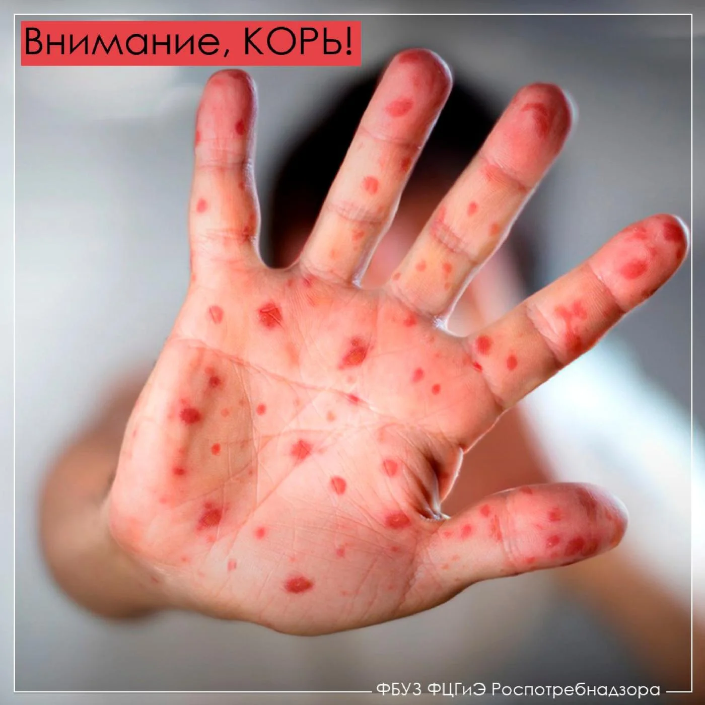 Внимание: корь!